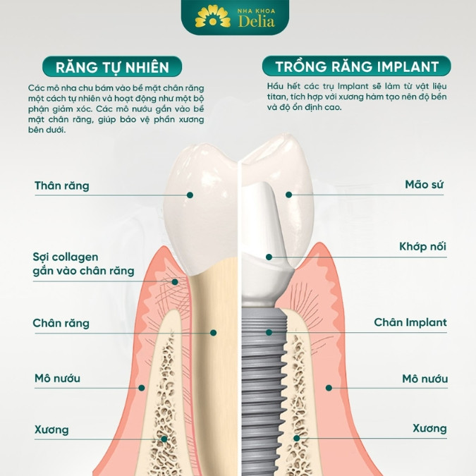 Tại sao trồng Implant là phương pháp trồng răng ngăn chặn tiêu xương hiệu quả nhất?