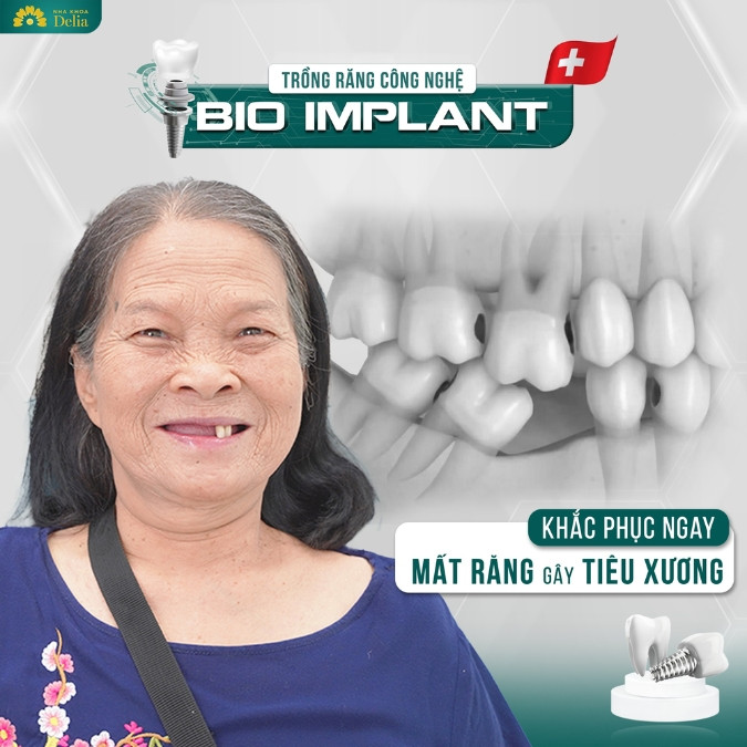 Tại sao trồng Implant là phương pháp trồng răng ngăn chặn tiêu xương hiệu quả nhất?