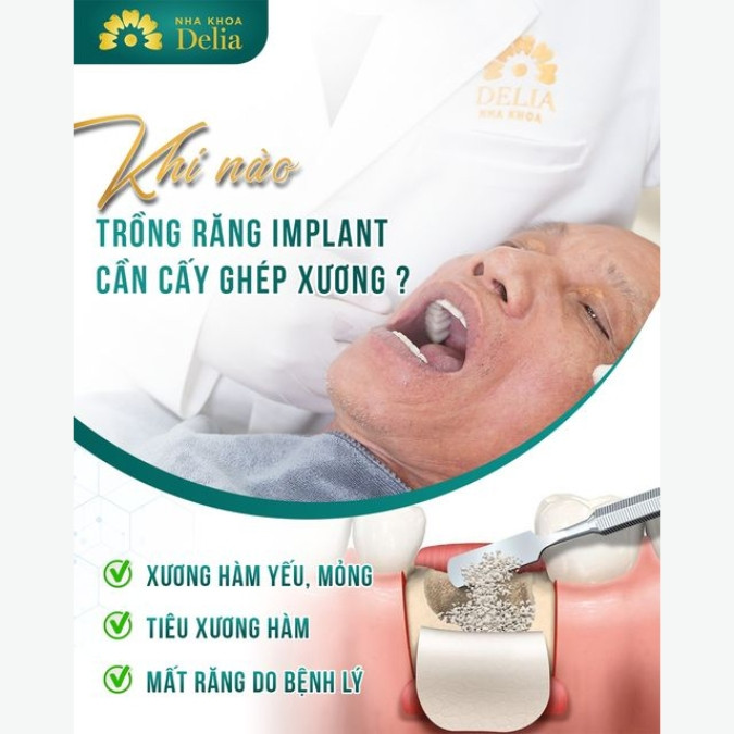 Xương hàm phải đáp ứng điều kiện gì để trồng răng thành công?