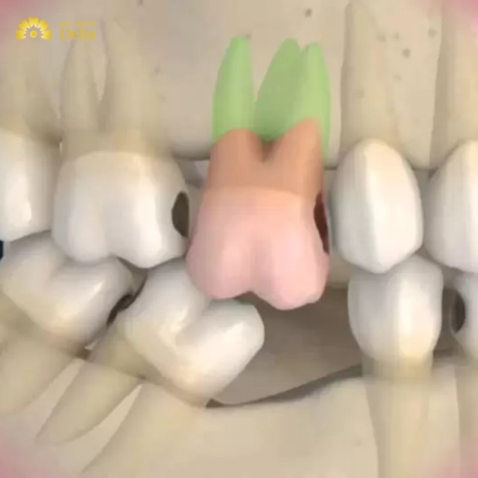 Tiêu xương răng có thể gây ra các biến chứng nguy hiểm như thế nào?