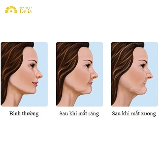 Tiêu xương răng có thể gây ra các biến chứng nguy hiểm như thế nào?
