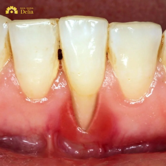 Nguyên nhân chính gây tiêu xương ổ răng
