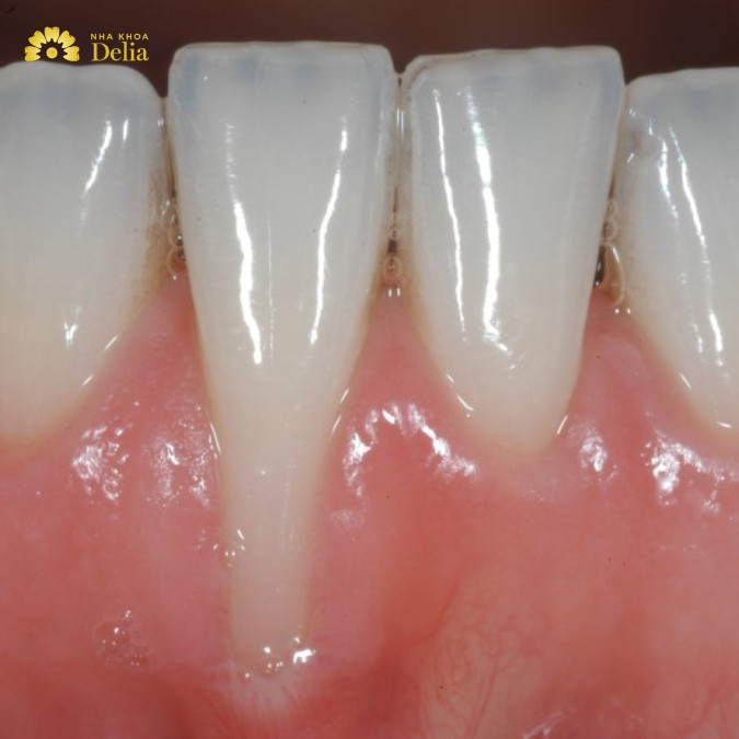 Tiêu xương răng có thể gây ra các biến chứng nguy hiểm như thế nào?