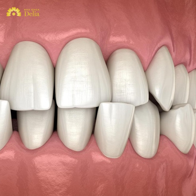Tiêu xương răng có thể gây ra các biến chứng nguy hiểm như thế nào?