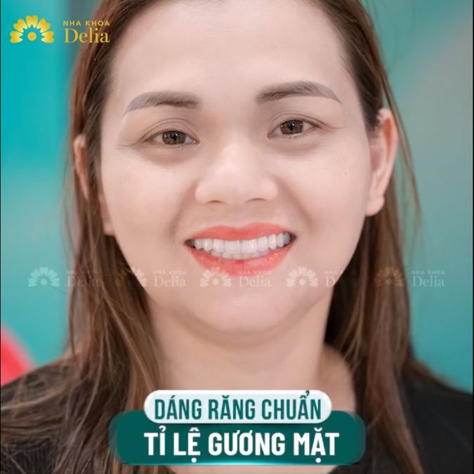 Tìm lại nụ cười đã mất sau khi bọc răng sứ hỏng – chị Trang Nguyễn