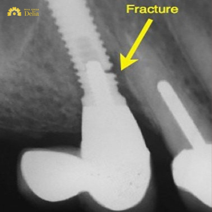 Sử dụng trụ Implant giá rẻ và nguy cơ bị đào thải cao