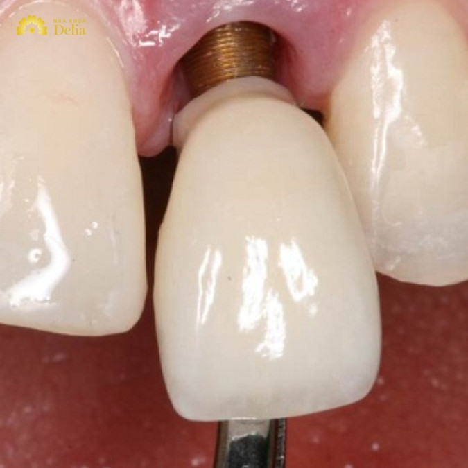 Sử dụng trụ Implant giá rẻ và nguy cơ bị đào thải cao