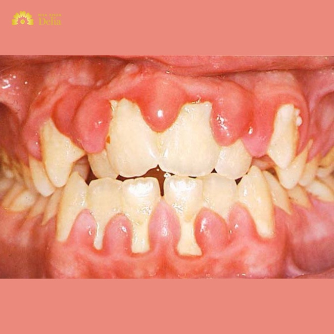 Một số nguyên nhân dẫn đến cấy ghép Implant thất bại 