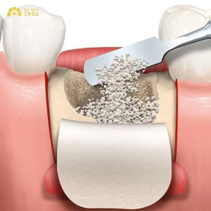 Một số nguyên nhân dẫn đến cấy ghép Implant thất bại 