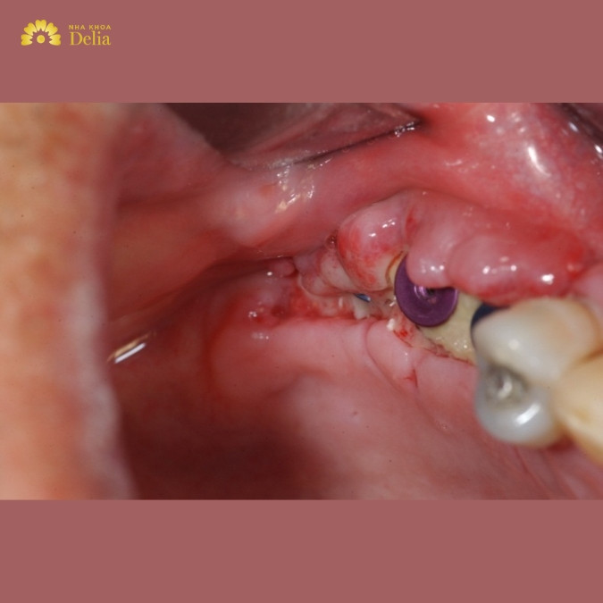 Các triệu chứng bất thường sau cấy Implant không nên coi thường 