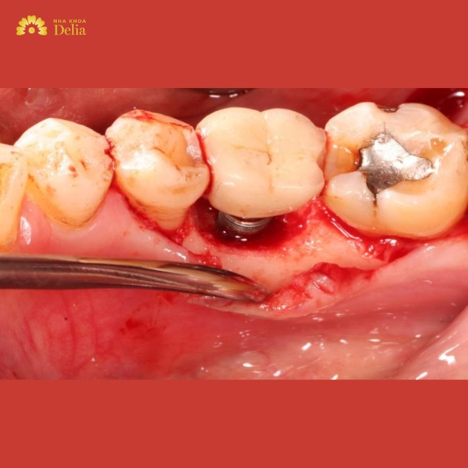 Các triệu chứng bất thường sau cấy Implant không nên coi thường 