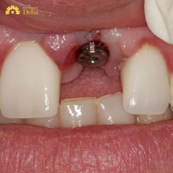 Các triệu chứng bất thường sau cấy Implant không nên coi thường 