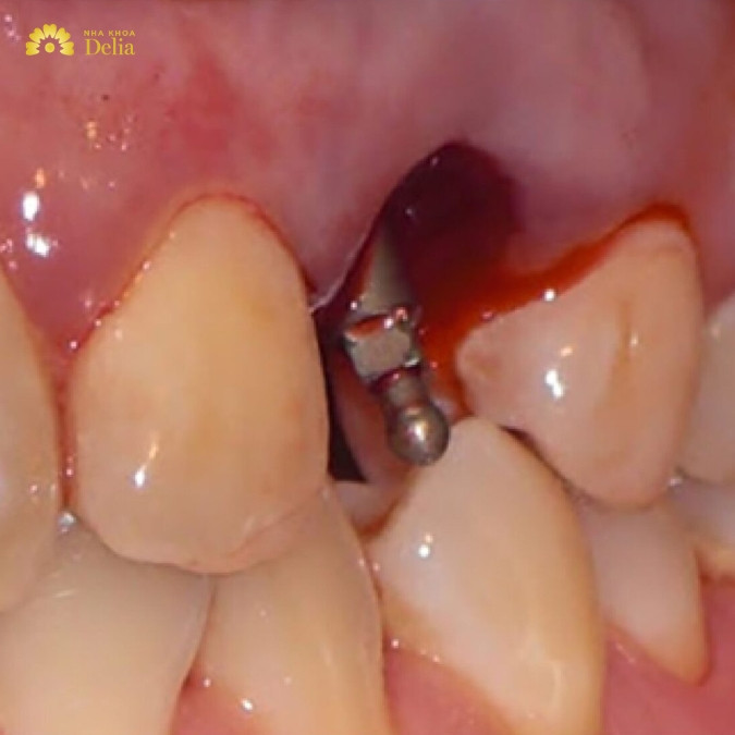 Sử dụng trụ Implant giá rẻ và nguy cơ bị đào thải cao