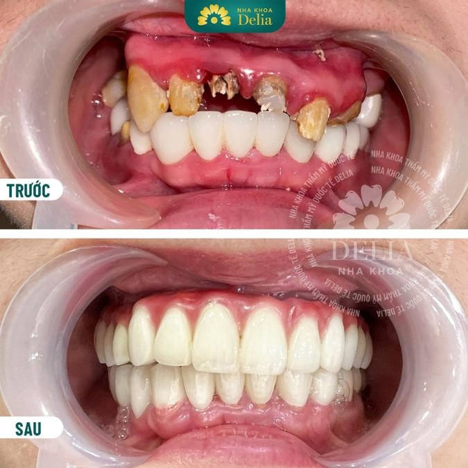 Đâu là phương pháp trồng răng cửa tốt nhất?