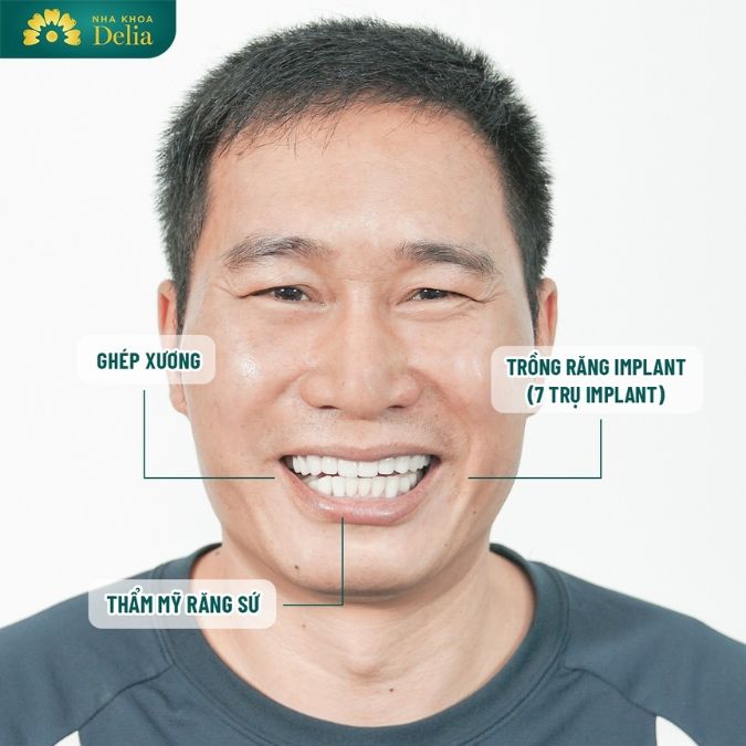 Trồng răng Implant là phương pháp gì?