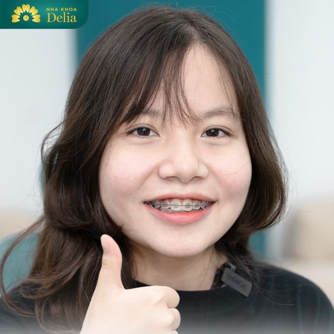 Trồng răng Implant có niềng răng được không? 