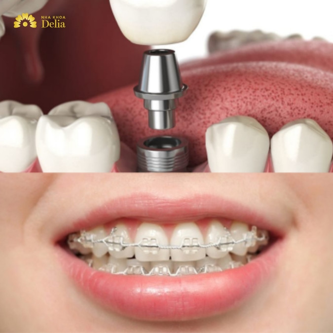 Trồng răng Implant có niềng răng được không