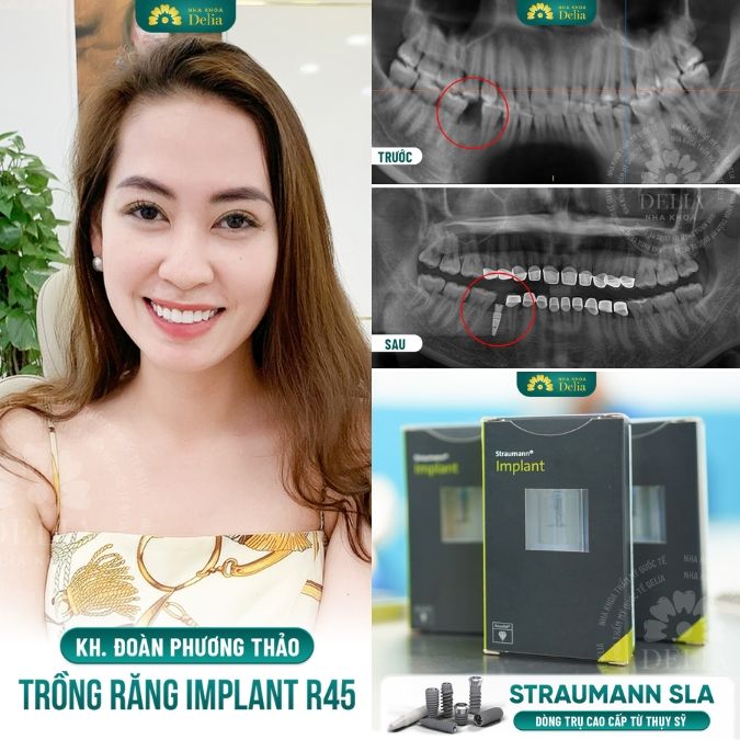 Trồng răng Implant có thể niềng răng trong những trường hợp nào? 
