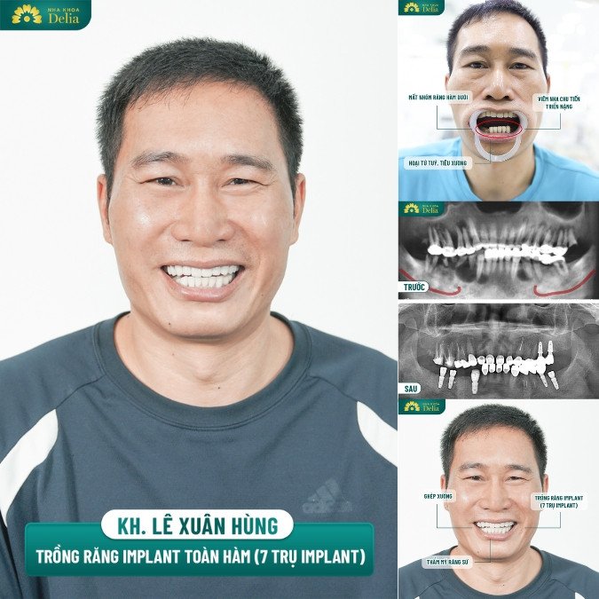 14+ Địa chỉ trồng răng Implant ở Quy Nhơn uy tín, an toàn nhất