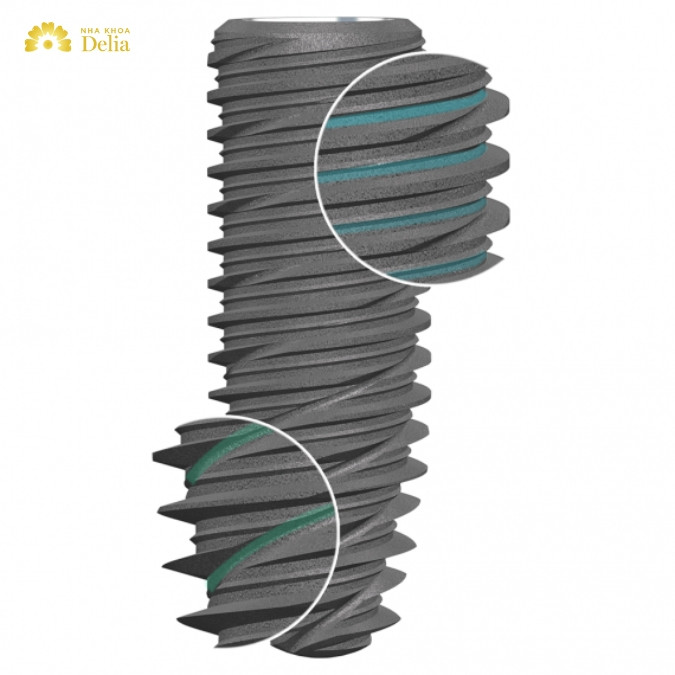 Trụ Implant Pháp có công nghệ gì nổi bật? 