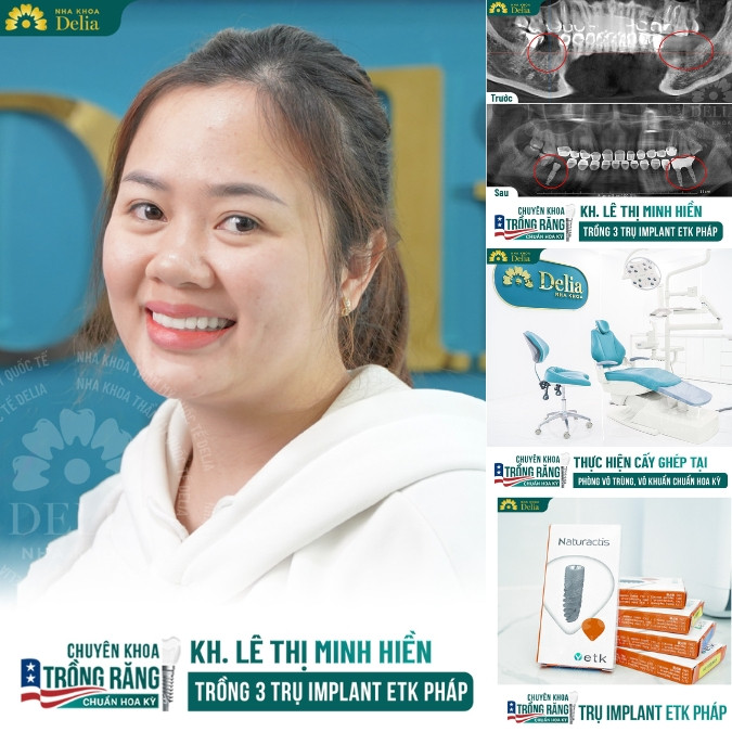 Đặc điểm của trụ Implant Pháp 