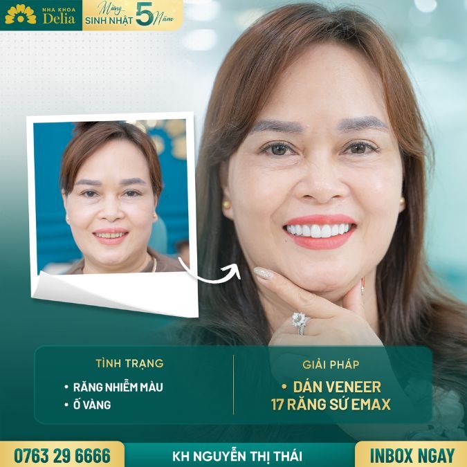 So với những dòng sứ khác như Celtra hay Lisi, Emax có mức giá rẻ hơn