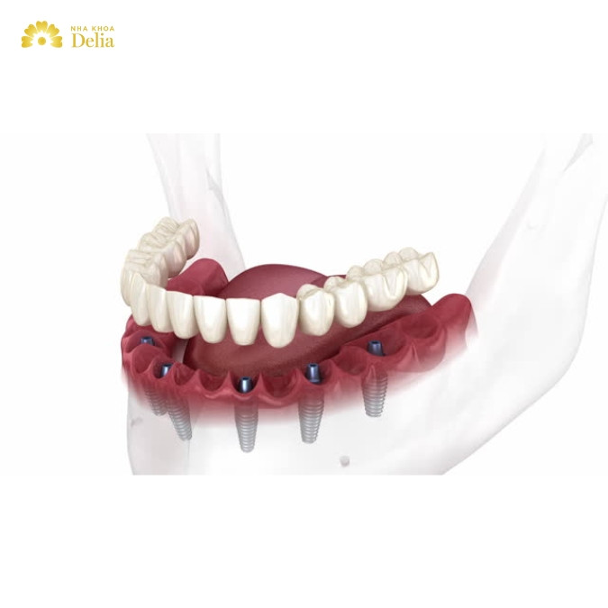 Công nghệ 3D Implant là gì? 