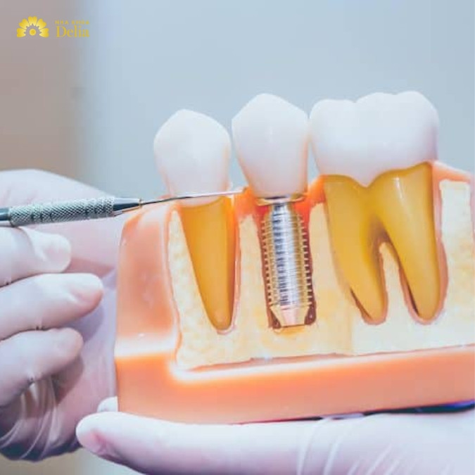 Công nghệ 3D Implant có vai trò gì trong cấy ghép Implant? 