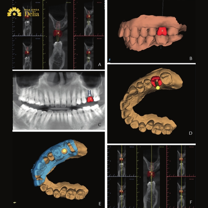 Ưu điểm vượt trội của công nghệ trồng Implant 3D là gì? 