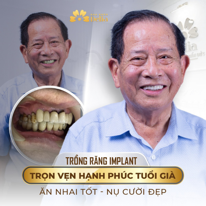 61 tuổi rụng gần hết răng trồng Implant như nào?
