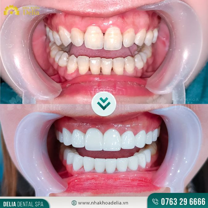 Thăm khám nha khoa định kỳ mỗi tháng 1 lần để kịp thời phát hiện và chữa trị bệnh nếu có
