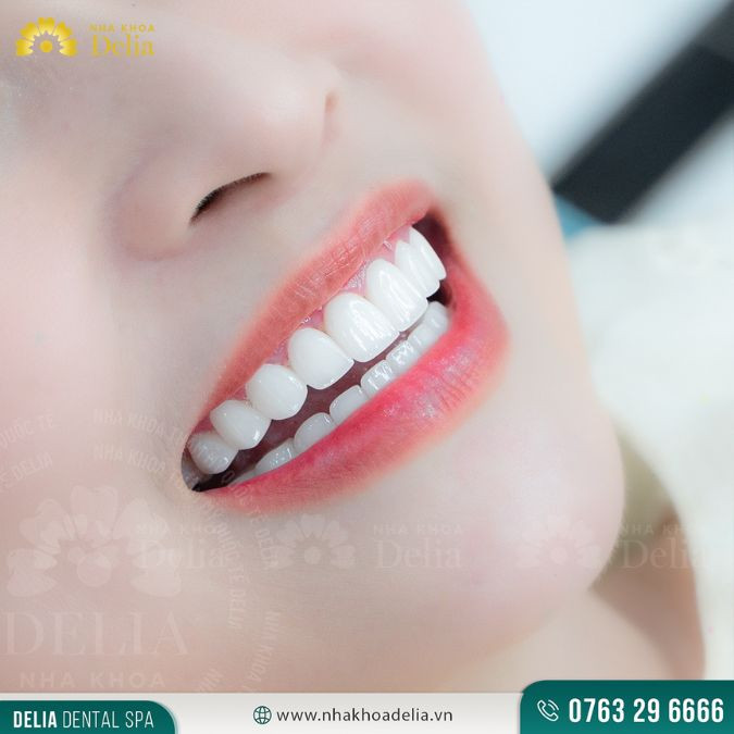 Từ việc bị hô 4 răng cửa chỉ Huế Bạch quyết định lựa chọn bọc răng sứ