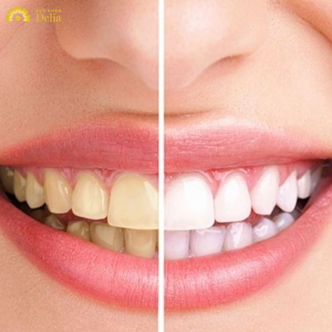 Tình trạng cao răng tích tụ lâu ngày không chỉ gây hôi miệng mà còn tăng nguy cơ mắc phải những bệnh lý nha khoa