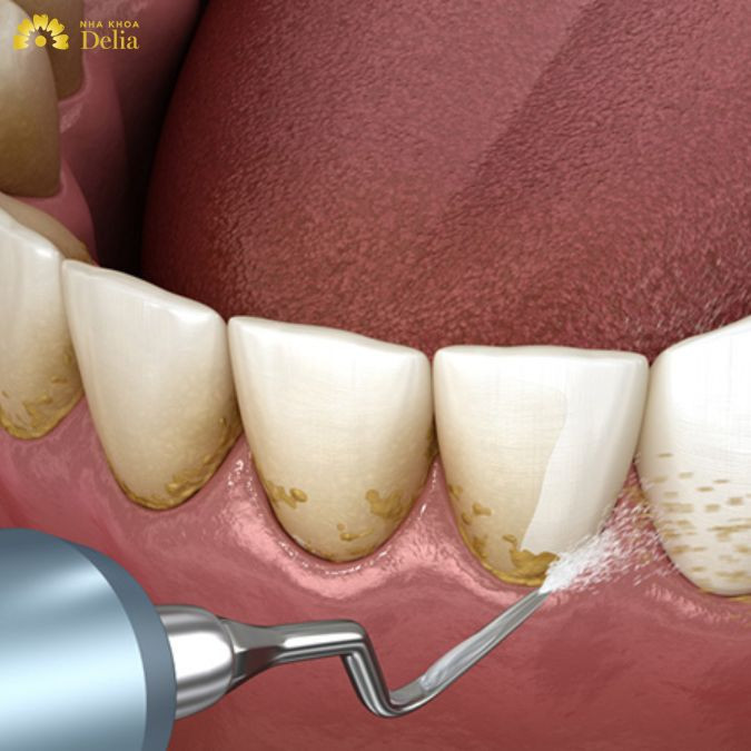 Mùi hôi ở miệng thường vào nhiều thời điểm trong ngày như sau khi ăn, khi mới thức dậy