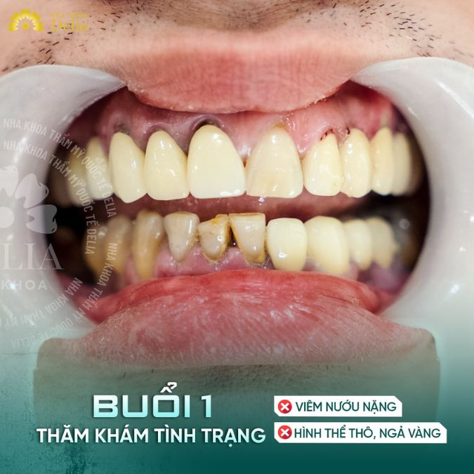 Mảng bám, cao răng không được làm sạch khiến cho vi khuẩn phát triển quá mức và gây ra tình trạng hôi miệng