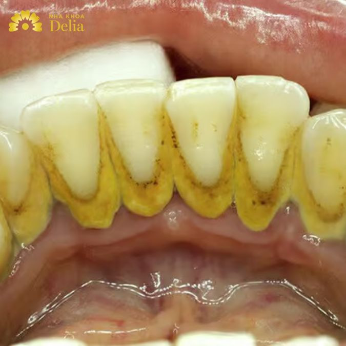 dưới tác động của những hợp chất muối vô cơ trong nước bọt và vi khuẩn nên cao răng dần bám chắc lại bề mặt răng