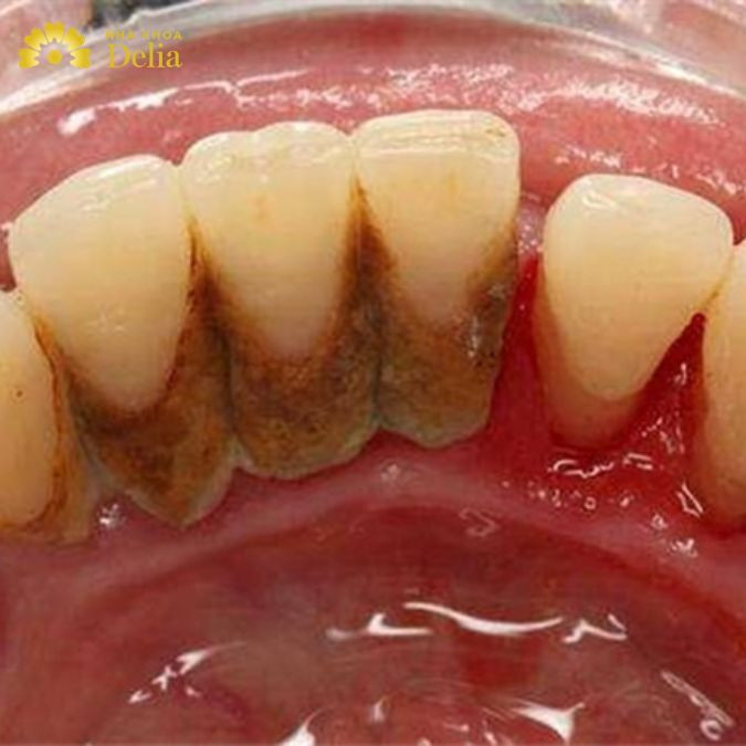 Những bệnh liên quan đến răng miệng