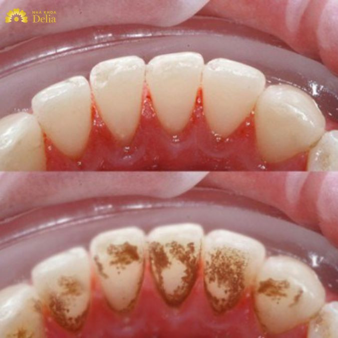 Nếu như cao răng để lâu mà không chữa trị thì sẽ hình thành, tích tụ ngày càng nhiều và tồn tại dai dẳng dẫn đến viêm nha chu