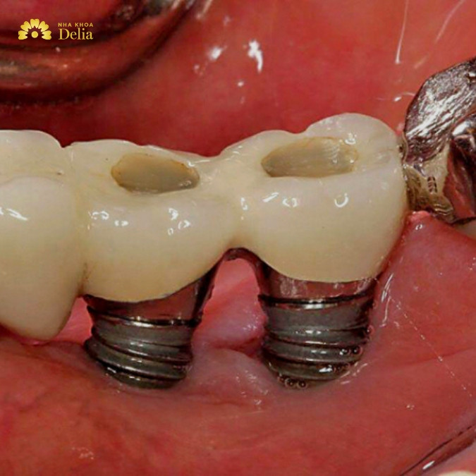 Trụ Implant bị đào thải nguyên nhân do đâu?