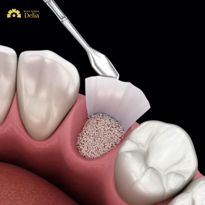 Ghép xương răng là gì? Có tác dụng gì?