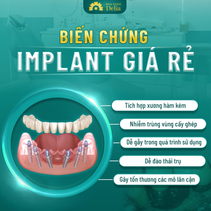 5 Hậu quả của việc cắm trụ Implant sai cách dẫn đến biến chứng nghiêm trọng