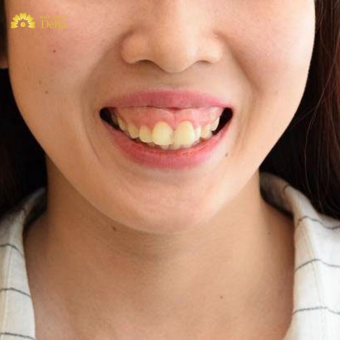 Hô xương ổ răng là gì? Gồ xương ổ răng là gì?