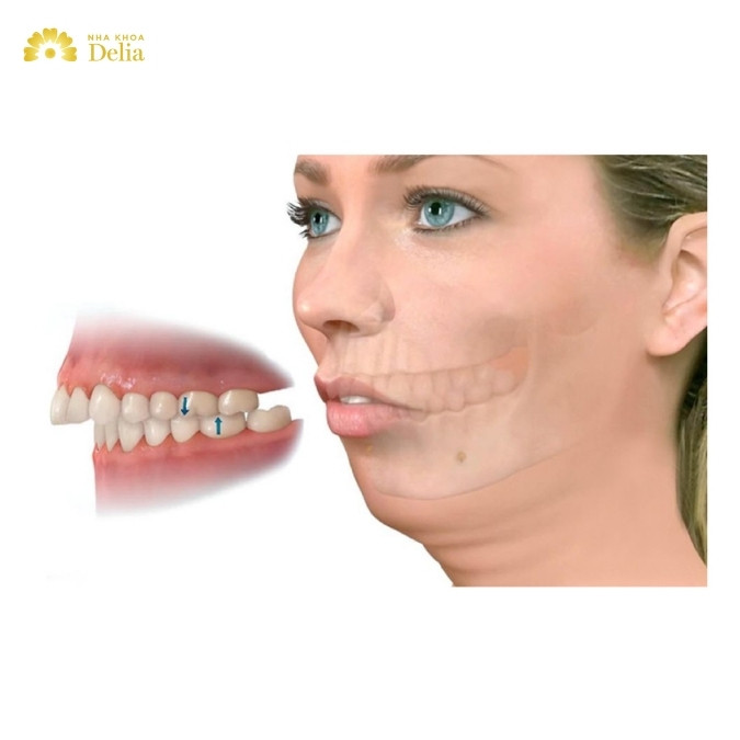 Hô xương ổ răng và hô hàm có giống nhau không?