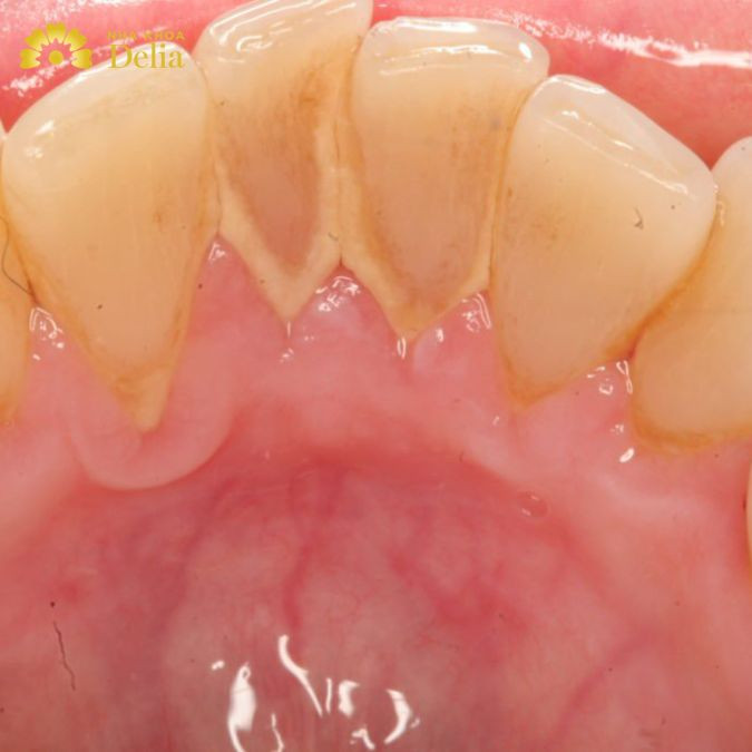 Cao răng mức độ nhẹ