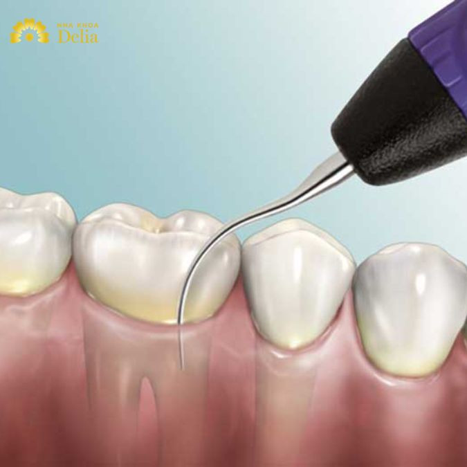 Bộ dụng cụ lấy cao răng tại nhà có thể dễ dàng tìm thấy ở nhiều cửa hàng thiết bị y tế