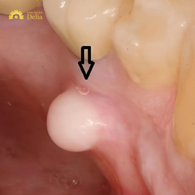 Lồi xương ổ răng là gì? Nguyên nhân nào gây ra lồi xương ổ răng? 
