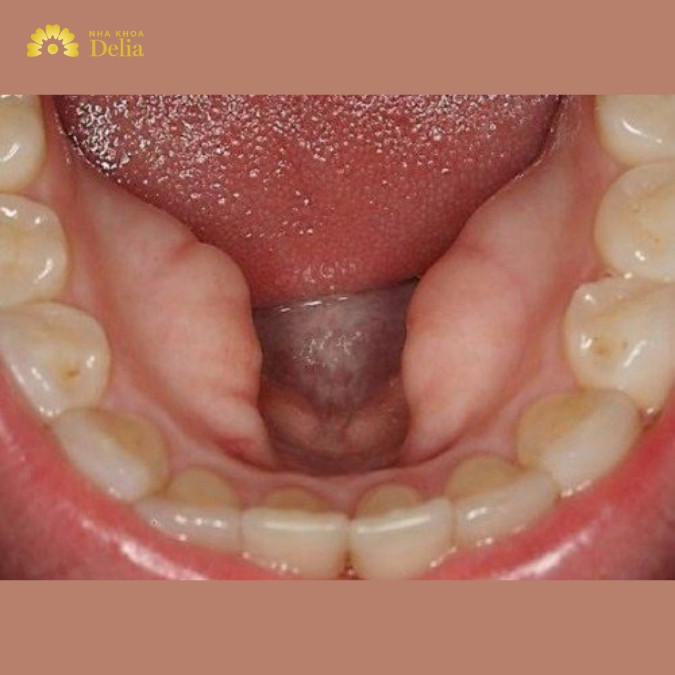 Các dạng lồi xương ổ răng phổ biến thường gặp 