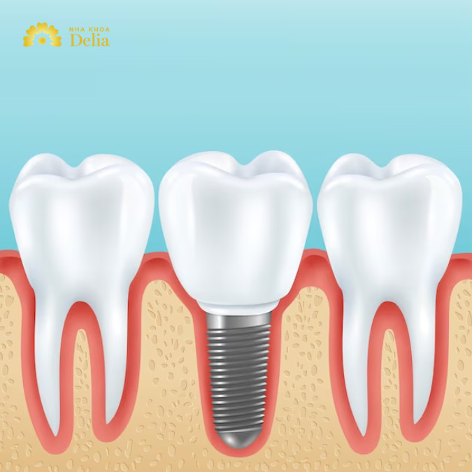 Hạn chế chạm vào vị trí cấy trụ tránh nhiễm trùng