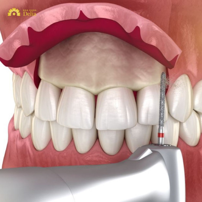Mài xương ổ răng có gây ảnh hưởng xấu đến xương hàm không?