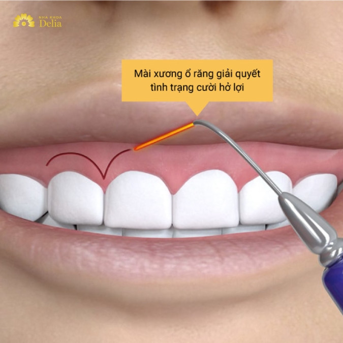 Mài xương ổ răng là gì? 
